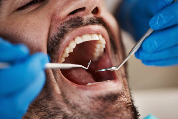 Best Emergency Wisdom Tooth Extraction in Lac Du Flambeau, WI